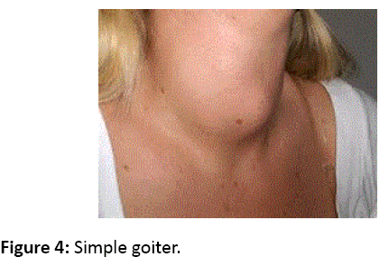 pharmacology-Simple-goiter